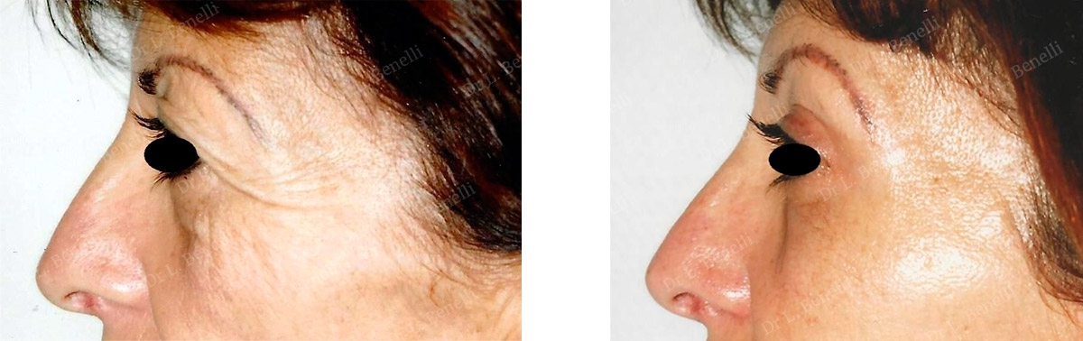 Photo de bl&eacute;pharoplastie sup&eacute;rieure r&eacute;alis&eacute; par le Dr Louis Benelli chirurgien esth&eacute;tique