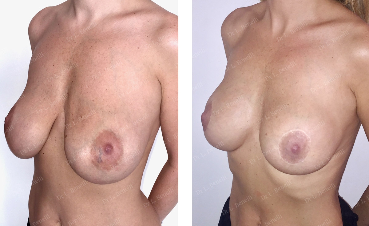 Correction de proth&egrave;ses affaiss&eacute;es par technique Round Block r&eacute;alis&eacute;e par le Dr Benelli