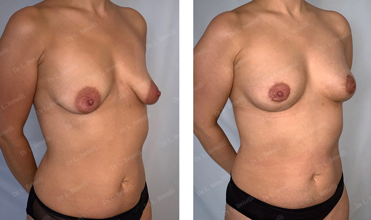 Correction de seins tub&eacute;reux par technique Round Block r&eacute;alis&eacute;e par le Dr Benelli