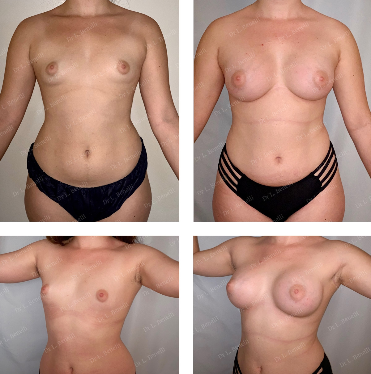 Correction des seins tub&eacute;reux r&eacute;alis&eacute;e par le Dr Louis Benelli chirurgien esth&eacute;tique