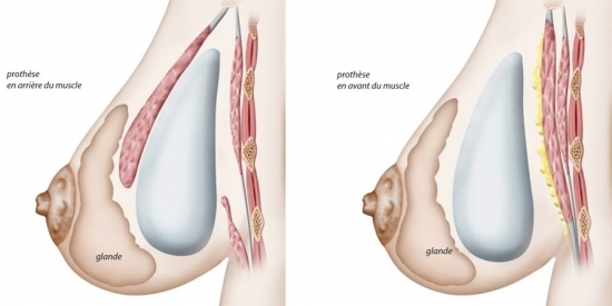 Diagram of the breast prostheses positioned in front of, or behind, the muscle