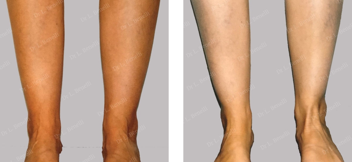 Photo avant après de lipoaspiration des chevilles par le Dr Benelli chirurgien plasticien