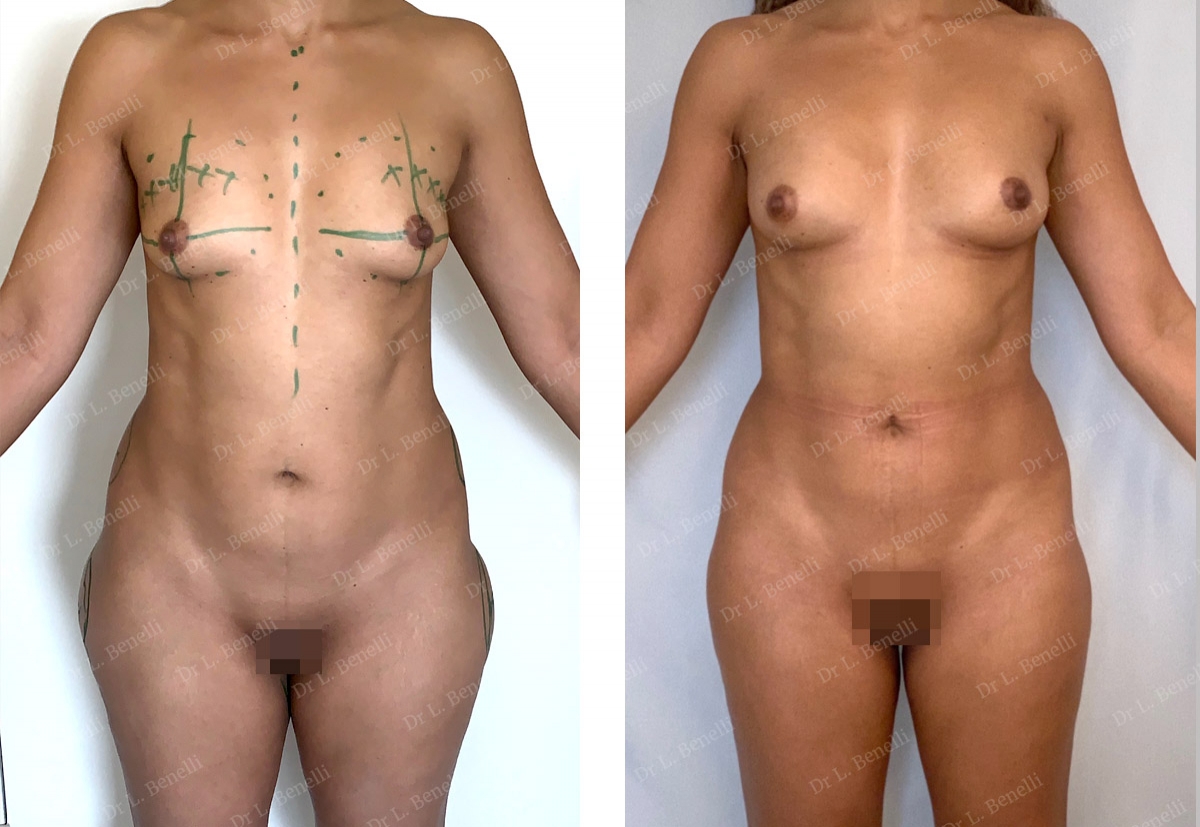 Lipofilling des seins r&eacute;alis&eacute;s par le Dr Benelli chirurgien plasticien
