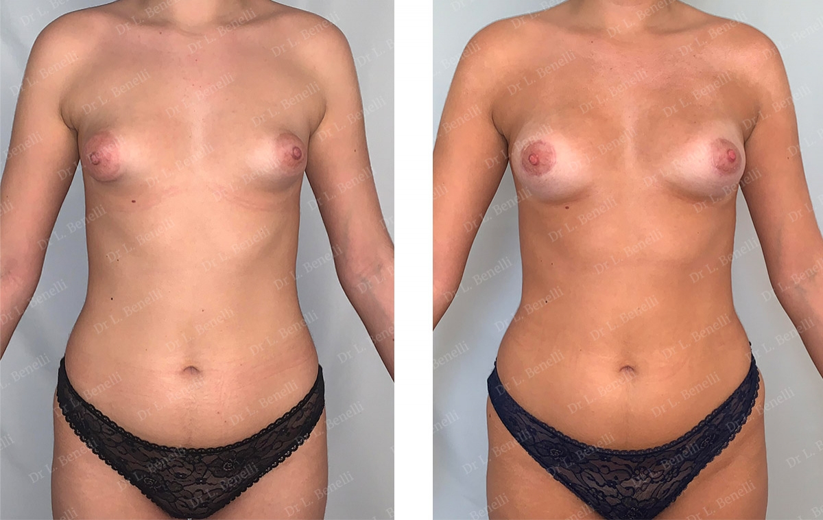 Photo avant / apr&egrave;s d'augmentation mammaire par lipofilling