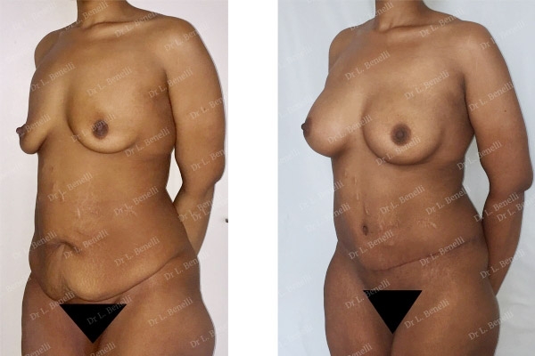 Photo augmentation mammaire r&eacute;alis&eacute;e par le Dr Louis Benelli chirurgien esth&eacute;tique