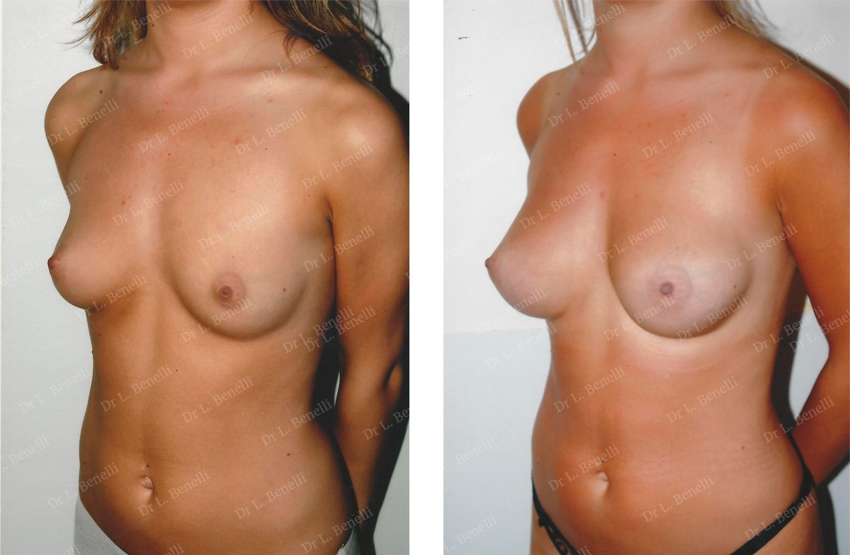 Photo augmentation mammaire r&eacute;alis&eacute;e par le Dr Louis Benelli chirurgien esth&eacute;tique