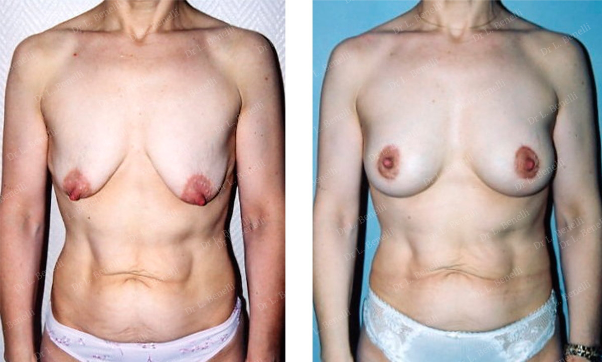 Photo augmentation mammaire r&eacute;alis&eacute;e par le Dr Louis Benelli chirurgien esth&eacute;tique