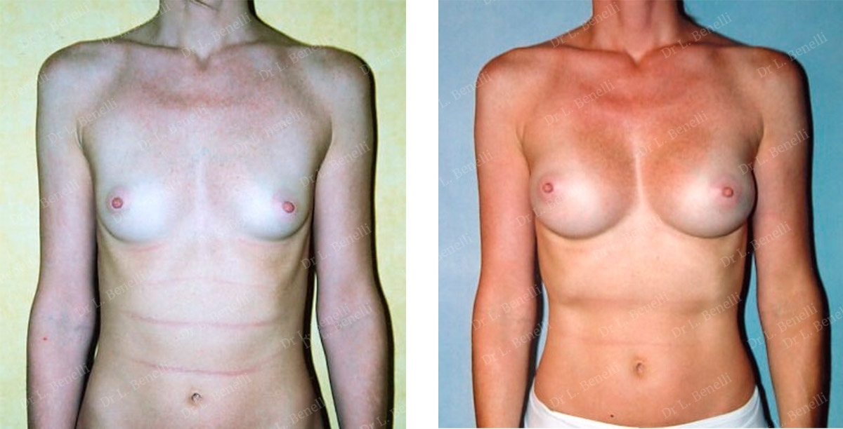 Photo augmentation mammaire r&eacute;alis&eacute;e par le Dr Louis Benelli chirurgien esth&eacute;tique