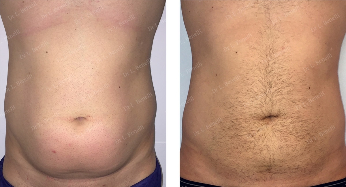 Photo avant apr&egrave;s de lipoaspiration homme par le Dr Benelli chirurgien esth&eacute;tique