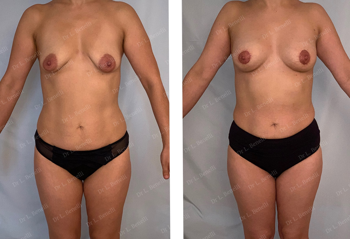 Photo avant apr&egrave;s de lipofilling des seins r&eacute;alis&eacute; par le Dr Benelli chirurgien plasticien