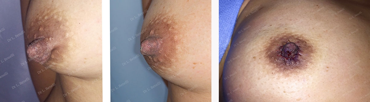 Photo avant / apr&egrave;s de r&eacute;duction des mamelons par le Dr Louis Benelli chirurgien esth&eacute;tique