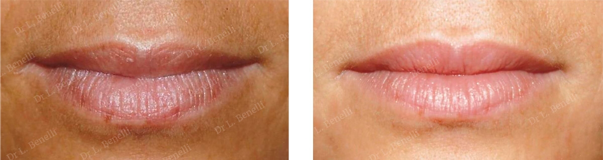Photo before and after aesthetic lip treatment by Dr. Benelli, plastic surgeon