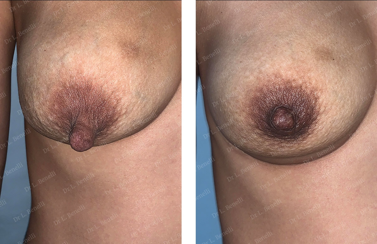 Photo de r&eacute;duction de mamelon par le Dr Benelli chirurgien esth&eacute;tique