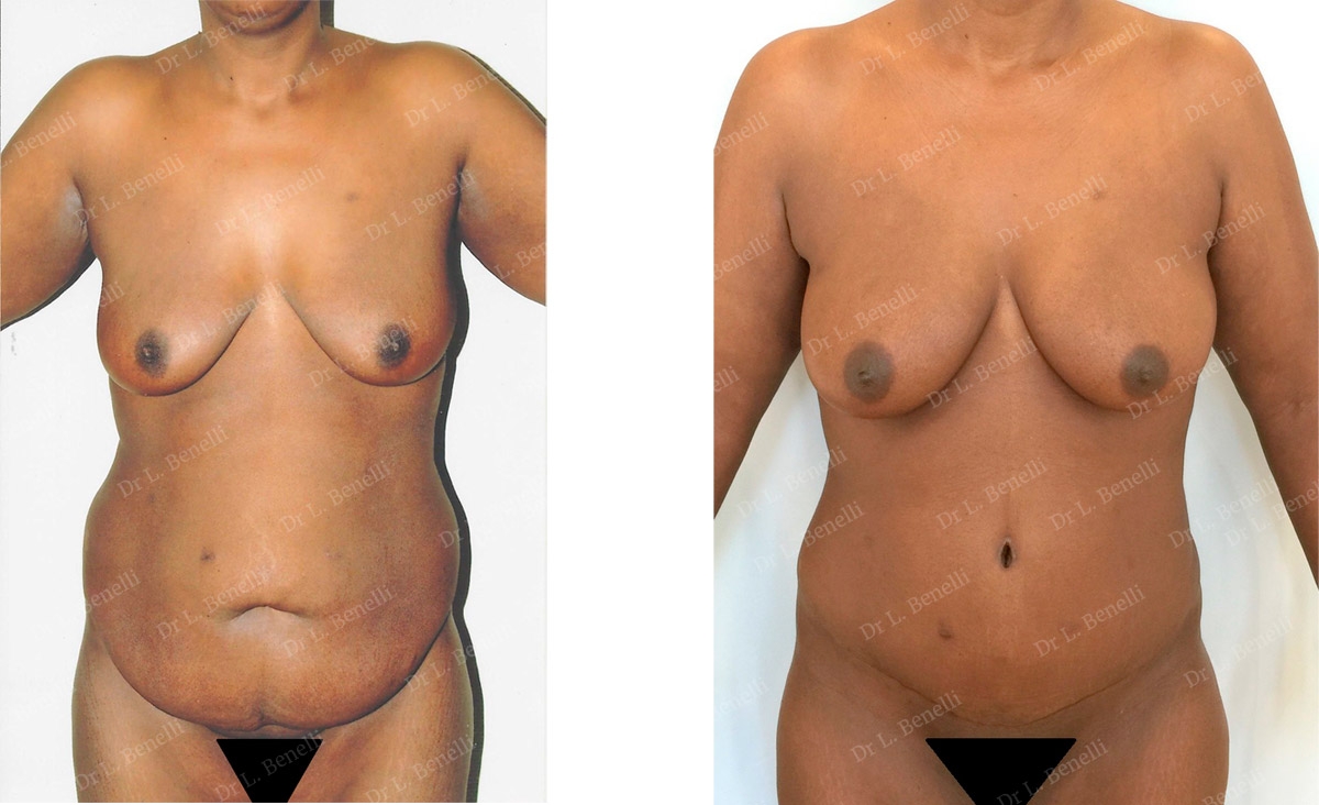 Photo of abdominoplasty performed by Dr. Louis Benelli, plastic surgeon