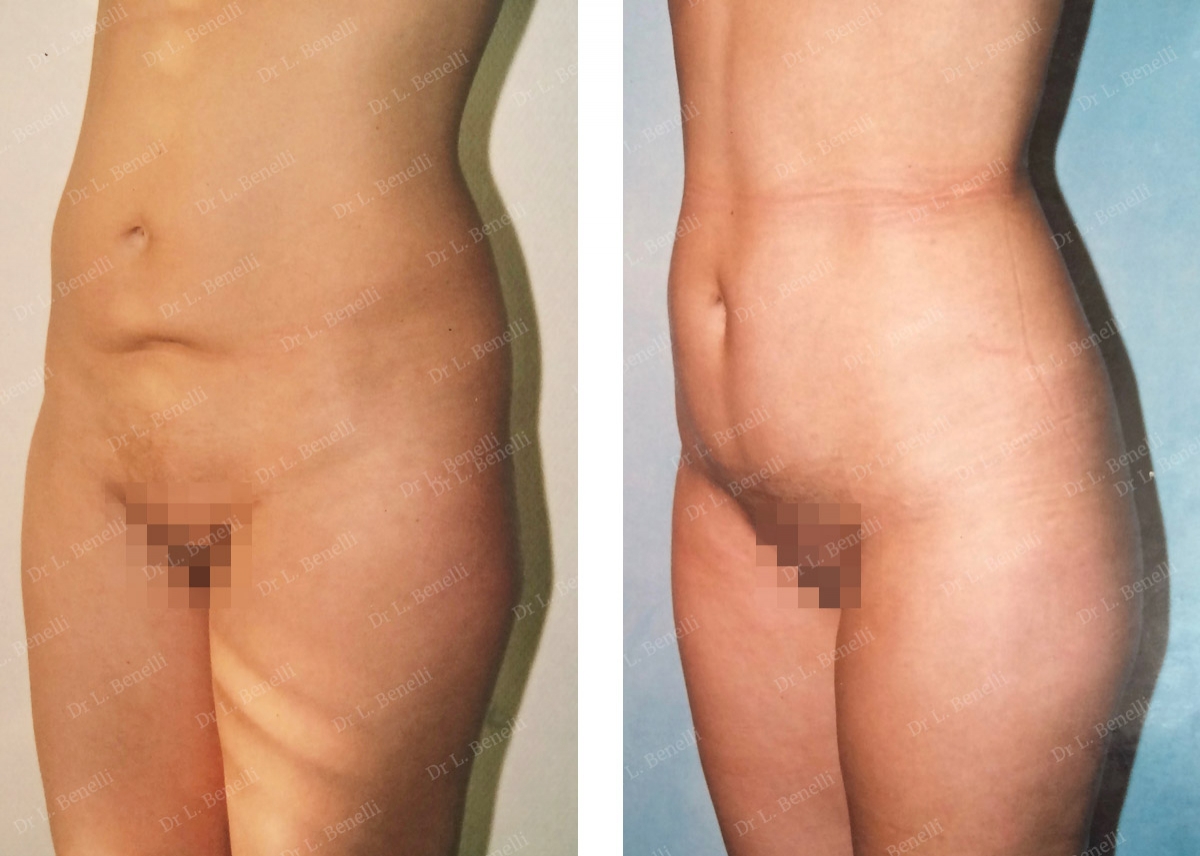 Reprise d'une cicatrice de césarienne par le Dr Benelli chirurgien plasticien