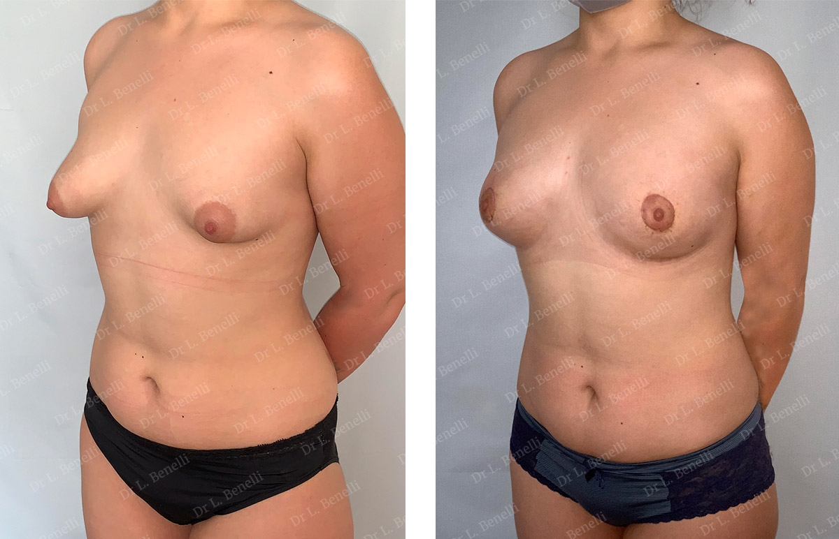 Photo avant / apr&egrave;s de seins tub&eacute;reux r&eacute;alis&eacute; par le Dr Louis Benelli chirurgien esth&eacute;tique