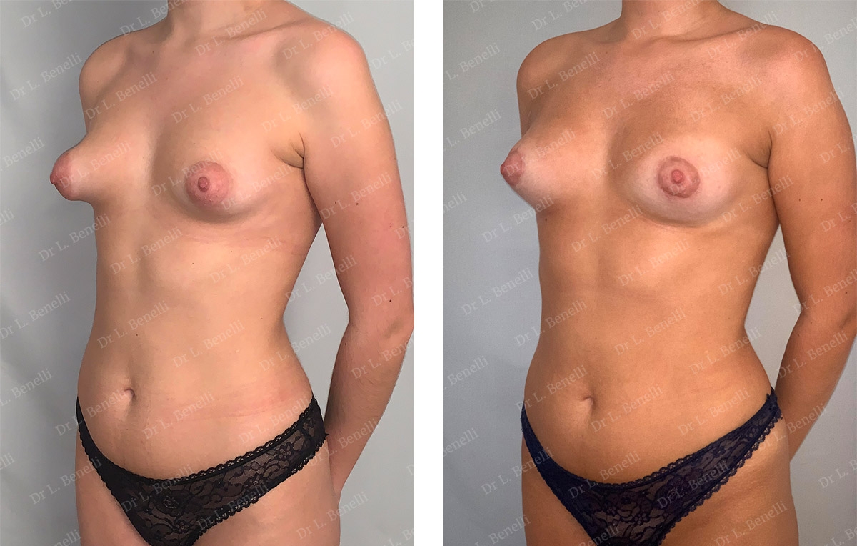 Photo avant / apr&egrave;s de seins tub&eacute;reux r&eacute;alis&eacute; par le Dr Louis Benelli chirurgien esth&eacute;tique