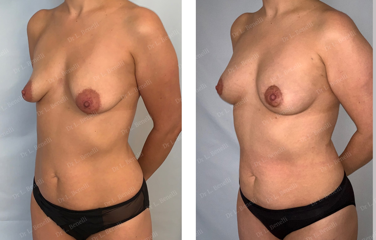 Traitement des seins tub&eacute;reux r&eacute;alis&eacute; par le Dr Louis Benelli chirurgien esth&eacute;tique